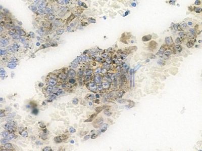 Gab2 Antibody - AF0106 at 1/100 staining human melanoma by IHC-P.
