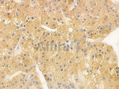 Cox1 Antibody - AF0138 at 1/100 staining human hepatocellular carcinoma by IHC-P.