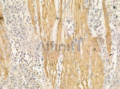 Cox1 Antibody - AF0138 at 1/100 staining human Hodgkin lymphoma by IHC-P.