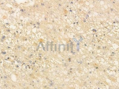 Cox1 Antibody - AF0138 at 1/100 staining human astrocytoma by IHC-P.
