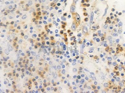Cyclin G Antibody - AF0145 at 1/100 staining human colon carcinoma by IHC-P.