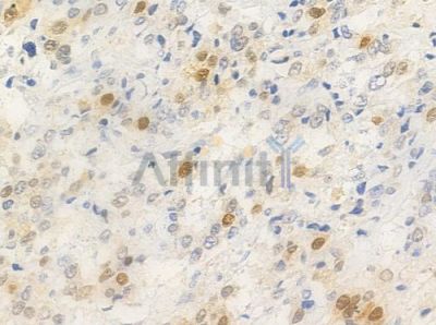 DNA Polymerase beta Antibody - AF0148 at 1/100 staining human prostate carcinoma by IHC-P.