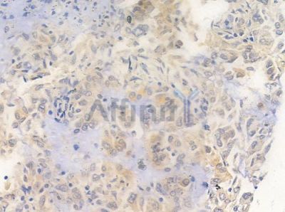 DNA Polymerase beta Antibody - AF0148 at 1/100 staining human lung adenocarcinoma by IHC-P.