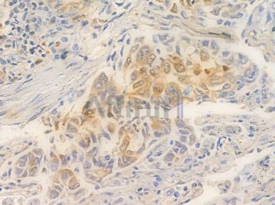 E2F6 Antibody - AF0152 at 1/100 staining human lung squamous cell carcinoma by IHC-P.