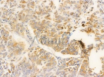 FGFR2 Antibody - AF0159 at 1/100 staining human lung squamous cell carcinoma by IHC-P.