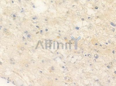 GluR5 Antibody - AF0169 at 1/100 staining human astrocytoma by IHC-P.