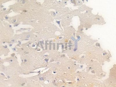 GluR5 Antibody - AF0169 at 1/100 staining human glioblastoma by IHC-P.