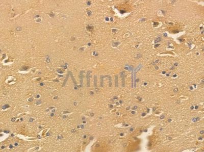 mGluR7 Antibody - AF0171 at 1/100 staining human glioblastoma by IHC-P.