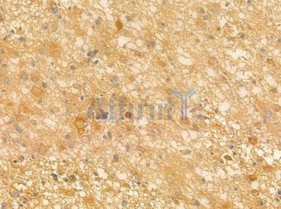 mGluR7 Antibody - AF0171 at 1/100 staining human astrocytoma by IHC-P.