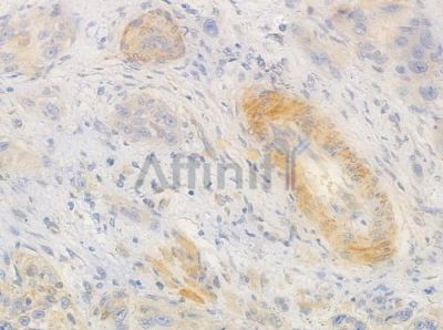 mGluR8 Antibody - AF0172 at 1/100 staining human tongue carcinoma by IHC-P.