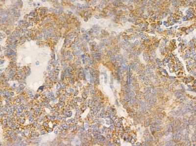 Grp75 Antibody - AF0176 at 1/100 staining human ovarian carcinoma by IHC-P.