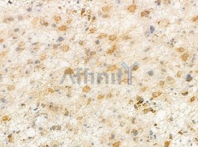 Grp75 Antibody - AF0176 at 1/100 staining human astrocytoma by IHC-P.
