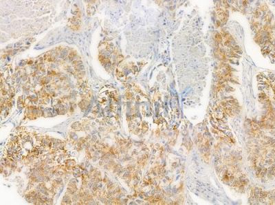 Grp75 Antibody - AF0176 at 1/100 staining human lung squamous cell carcinoma by IHC-P.