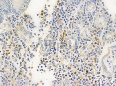 HDAC7 Antibody - AF0180 at 1/100 staining human colon carcinoma by IHC-P.