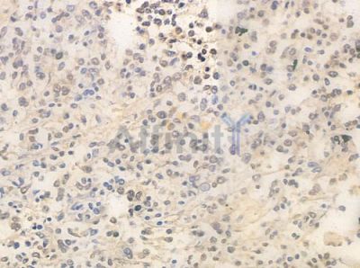 HDAC7 Antibody - AF0180 at 1/100 staining human Hodgkin lymphoma by IHC-P.