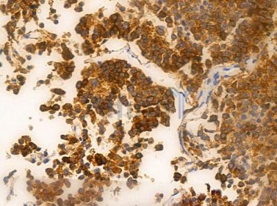HDAC9 Antibody - AF0181 at 1/100 staining human pituitary adenoma by IHC-P.