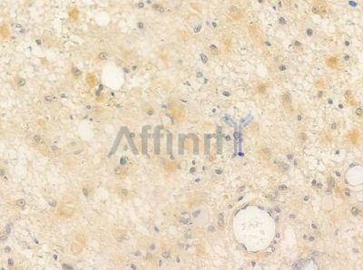 NRG1 Antibody - AF0182 at 1/100 staining human astrocytoma by IHC-P.