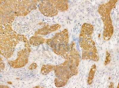 Cytokeratin 17 Antibody - AF0190 at 1/100 staining human cervical carcinoma by IHC-P.