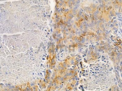 Cytokeratin 17 Antibody - AF0190 at 1/100 staining human lung squamous cell carcinoma by IHC-P.