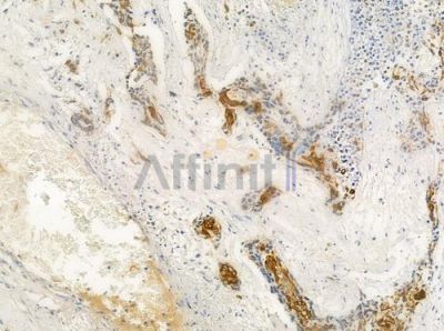 Cytokeratin 17 Antibody - AF0190 at 1/100 staining human breast carcinoma by IHC-P.