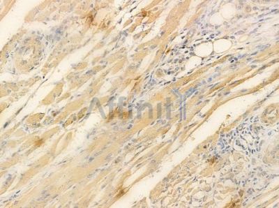 NSE Antibody - AF0223 at 1/100 staining human tongue carcinoma by IHC-P.