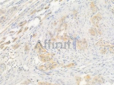 p15 INK4b Antibody - AF0230 at 1/100 staining human tongue carcinoma by IHC-P.