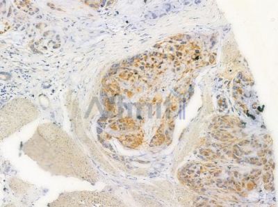 PDGF Receptor alpha Antibody - AF0241 at 1/100 staining human gastric carcinoma by IHC-P.