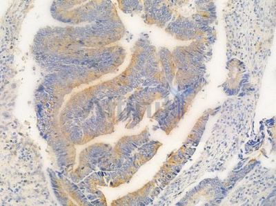 Presenilin 1 Antibody - AF0245 at 1/100 staining human colon carcinoma by IHC-P.