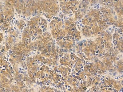 Retinoic Acid Receptor beta Antibody - AF0249 at 1/100 staining human thymoma by IHC-P.