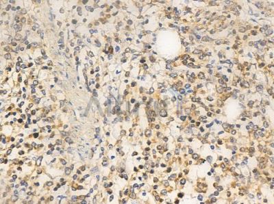 Retinoic Acid Receptor beta Antibody - AF0249 at 1/100 staining human Hodgkin lymphoma by IHC-P.