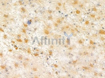 Retinoic Acid Receptor beta Antibody - AF0249 at 1/100 staining human astrocytoma by IHC-P.