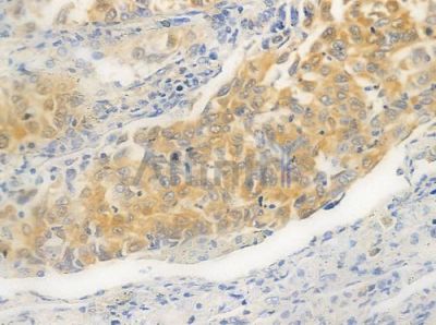 TGFB3 Antibody - AF0261 at 1/100 staining human lung squamous cell carcinoma by IHC-P.
