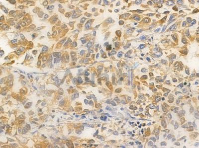 TGFB3 Antibody - AF0261 at 1/100 staining human lung squamous cell carcinoma by IHC-P.