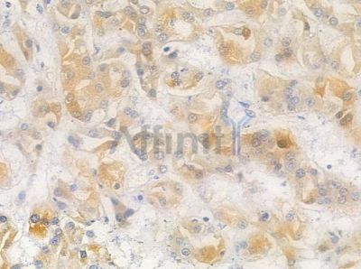 TGFB3 Antibody - AF0261 at 1/100 staining human renal cell carcinoma by IHC-P.