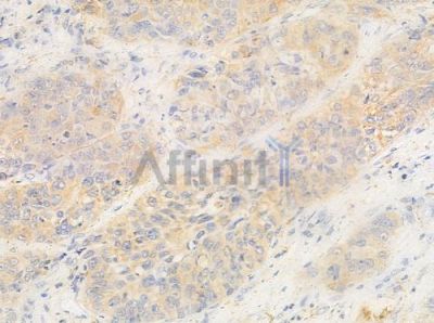 CDK7 Antibody - AF0267 at 1/100 staining human lung squamous cell carcinoma by IHC-P.