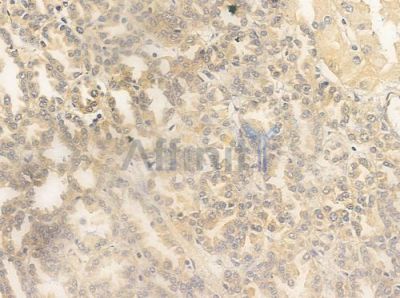 CDK7 Antibody - AF0267 at 1/100 staining human renal cell carcinoma by IHC-P.