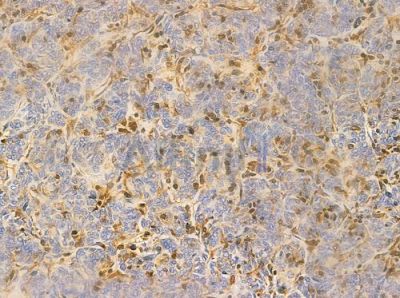 EDD Antibody - AF0268 at 1/100 staining human thymoma by IHC-P.