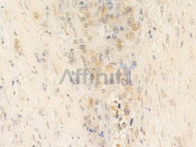 SENP7 Antibody - AF0278 at 1/100 staining human prostate carcinoma by IHC-P.