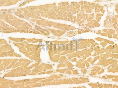 Tubulin gamma Antibody - AF0285 at 1/100 staining human tongue carcinoma by IHC-P.