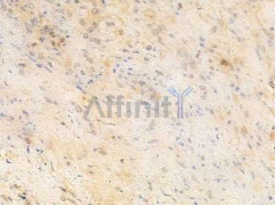 XRCC1 Antibody - AF0296 at 1/100 staining human prostate carcinoma by IHC-P.