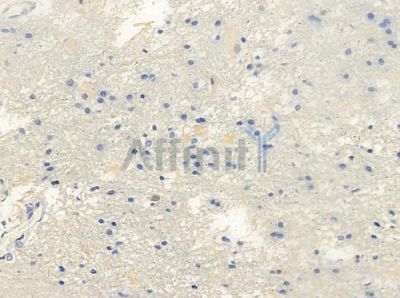 DLGAP1 Antibody - AF0308 at 1/100 staining human glioblastoma by IHC-P.
