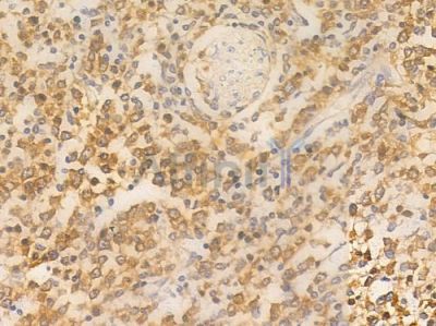 Clock Antibody - AF0323 at 1/100 staining human Hodgkin lymphoma by IHC-P.