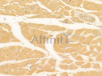 TWEAK Antibody - AF0328 at 1/100 staining human tongue carcinoma by IHC-P.