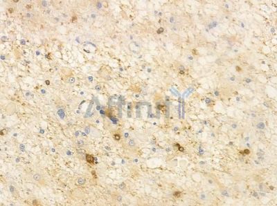 DLX3 Antibody - AF0339 at 1/100 staining human astrocytoma by IHC-P.