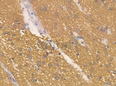 CIB2 Antibody - AF0349 at 1/100 staining human glioblastoma by IHC-P.
