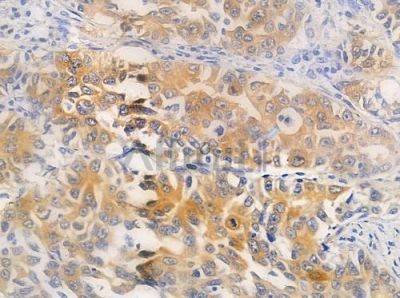 CIB2 Antibody - AF0349 at 1/100 staining human lung squamous cell carcinoma by IHC-P.