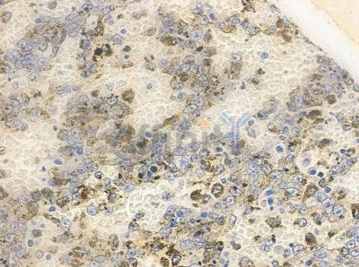 CDKA2 Antibody - AF0350 at 1/100 staining human melanoma by IHC-P.