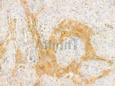 NDUC2 Antibody - AF0351 at 1/100 staining human tongue carcinoma by IHC-P.