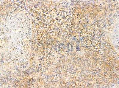NDUC2 Antibody - AF0351 at 1/100 staining human cervical carcinoma by IHC-P.