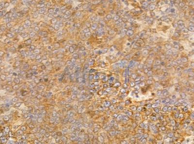 NDUC2 Antibody - AF0351 at 1/100 staining human melanoma by IHC-P.